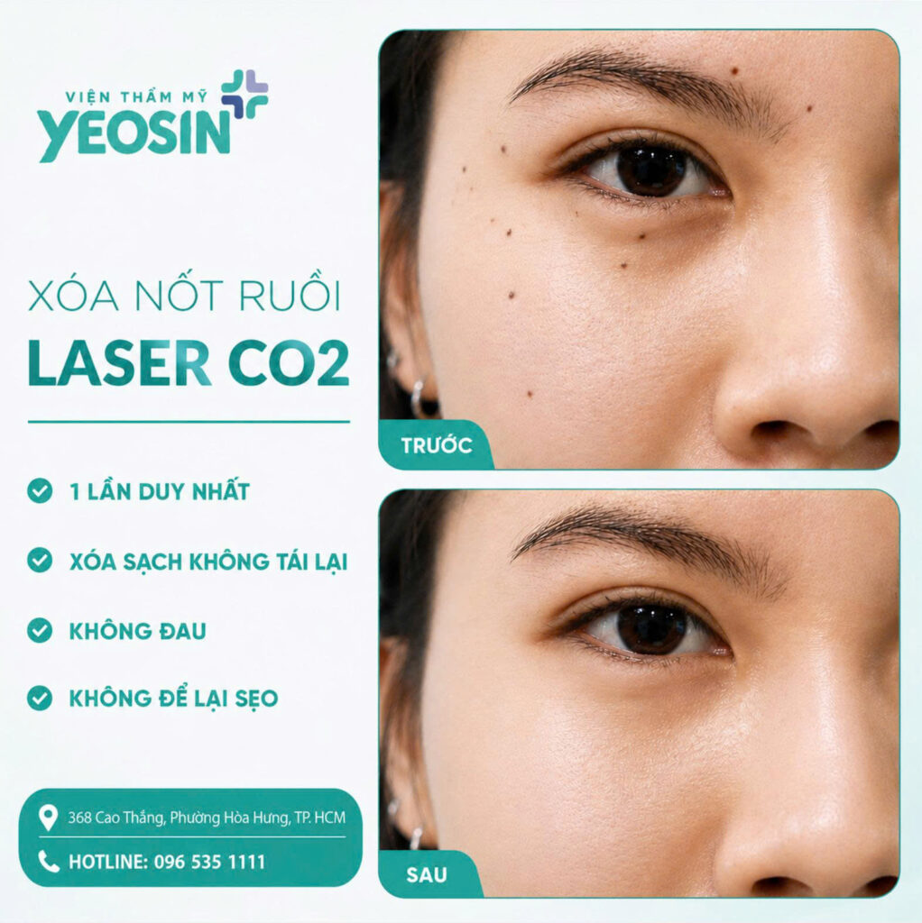 Xoa not ruoi Cong nghe Laser CO2 1