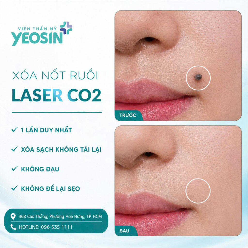 Xoa not ruoi Cong nghe Laser CO2