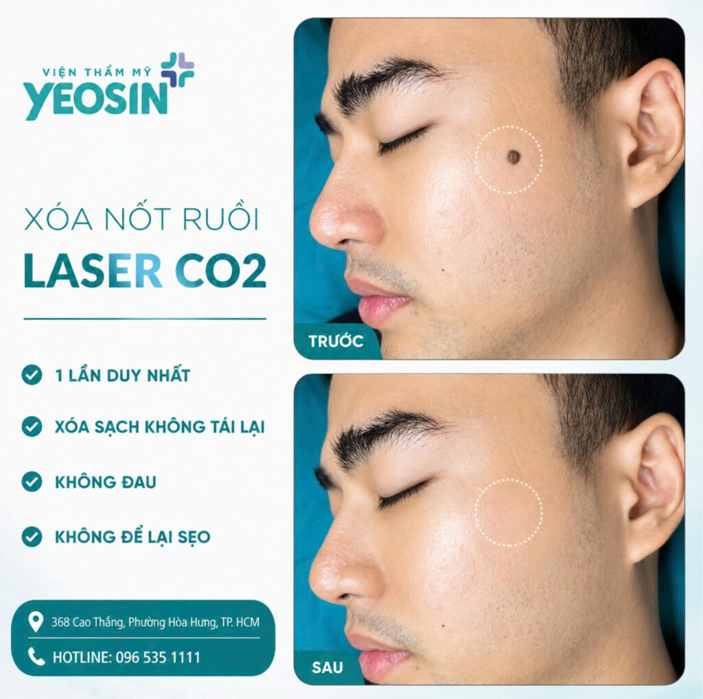 Xoa not ruoi Cong nghe Laser CO2 2