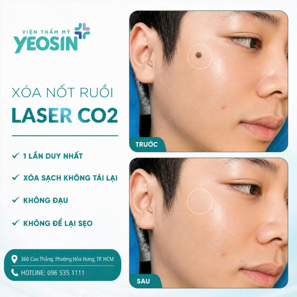 Xoa not ruoi Cong nghe Laser CO2 3