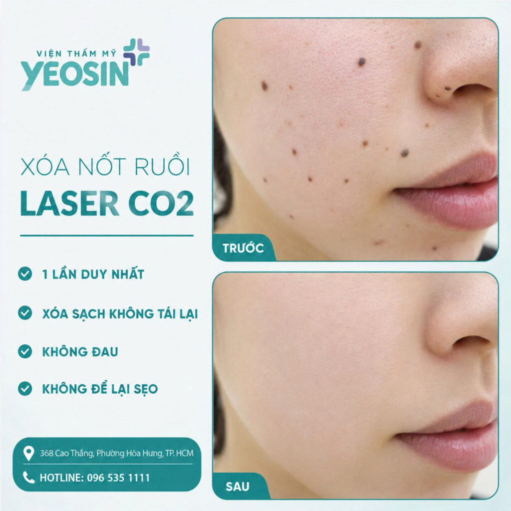 Xoa not ruoi Cong nghe Laser CO2 4