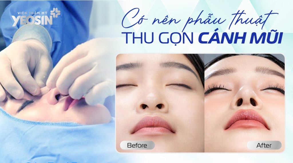 Các ưu điểm của phương pháp thẩm mỹ thu gọn cánh mũi.