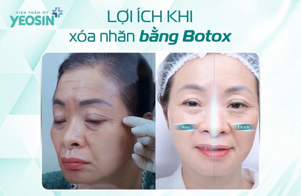 Lợi ích khi xóa nhăn vùng mắt bằng Botox