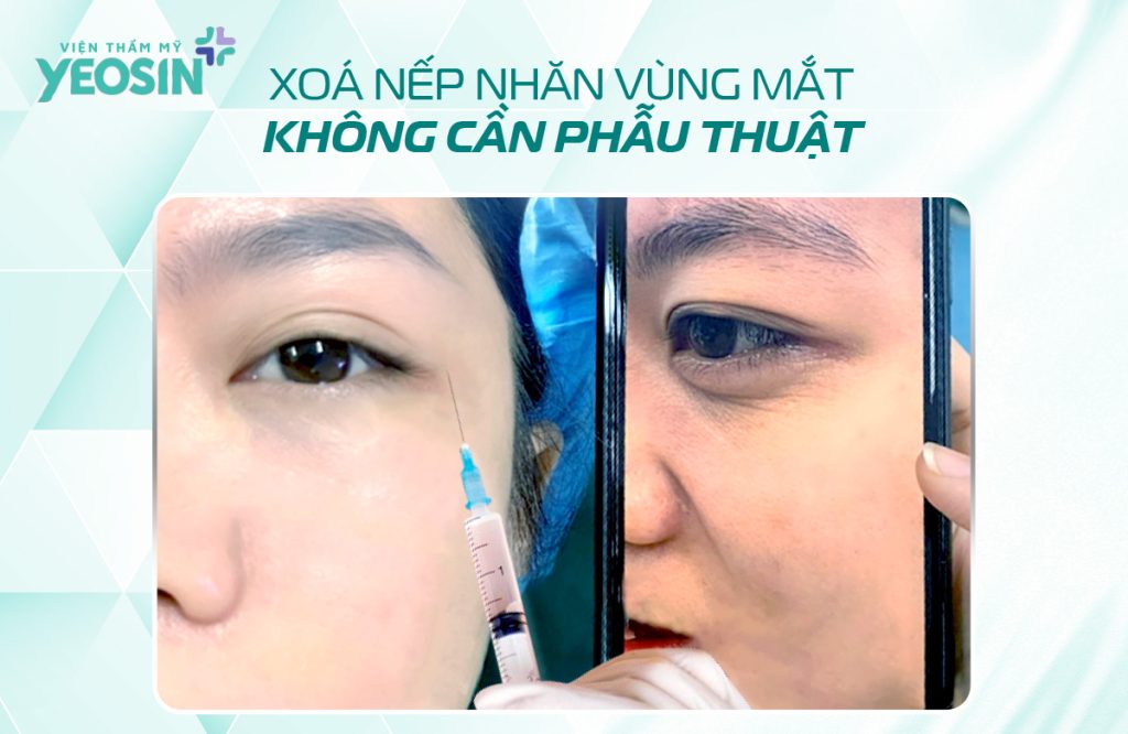 Xóa nếp nhăn vùng mắt không cần phẫu thuật