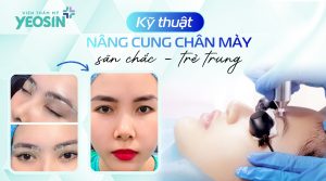 Nâng cung chân mày giấu chỉ