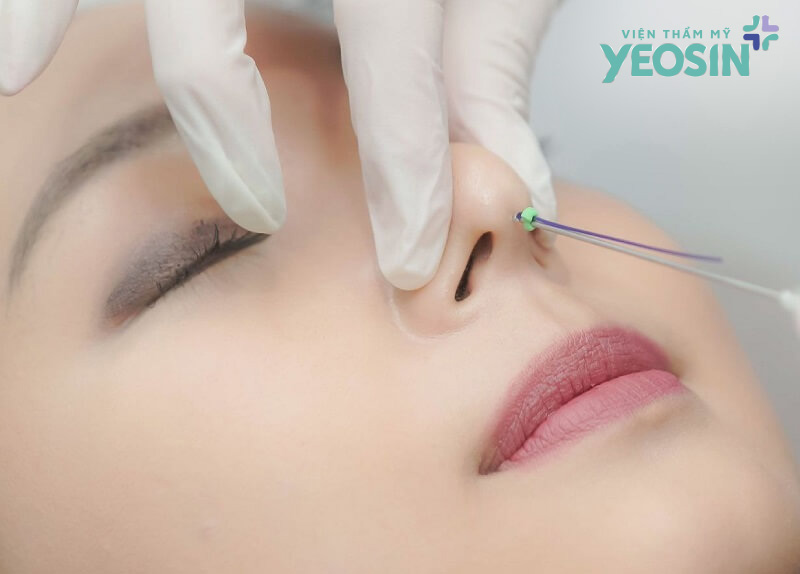 Lợi ích khi nâng mũi bằng chỉ collagen