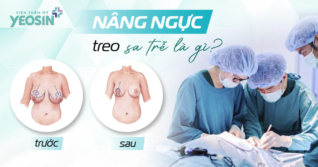 Nâng ngực treo sa trễ là gì?