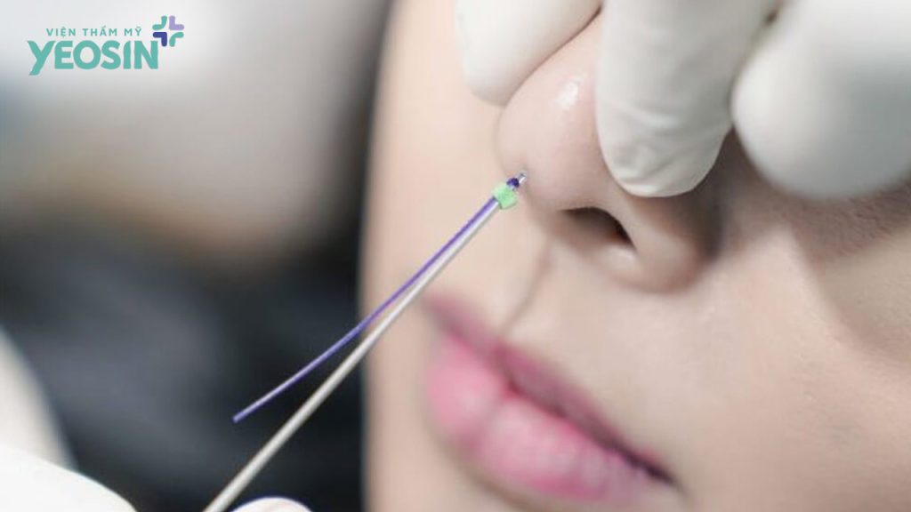 Nâng mũi bằng chỉ collagen có an toàn không?