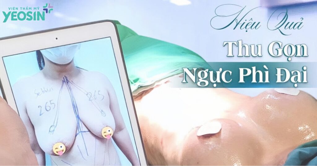 Nâng ngực - Thu gọn ngực phì đại bằng phương pháp cắt tuyến 10 quality restoration 20260910172611639