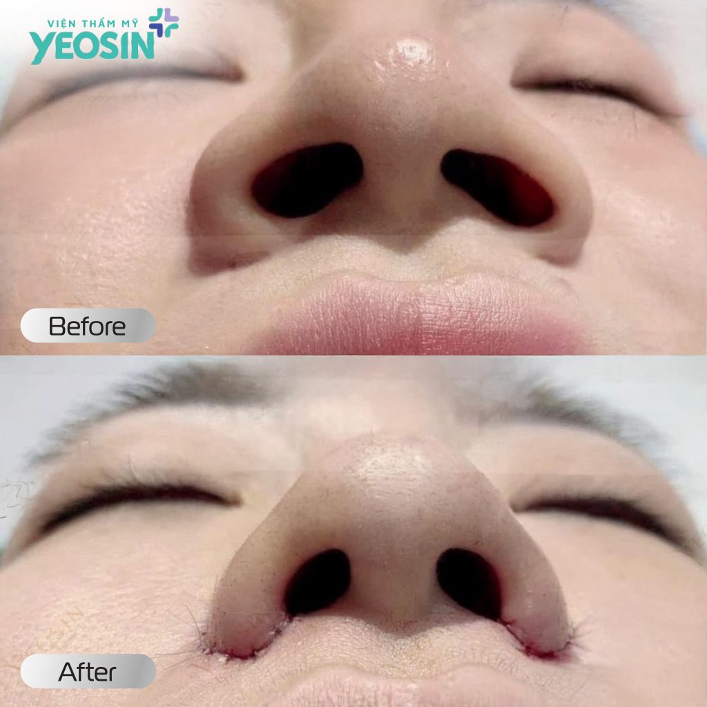 Những ai nên thực hiện thu gọn cánh mũi?