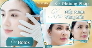 xoa nep nhan vung mat bang tobox