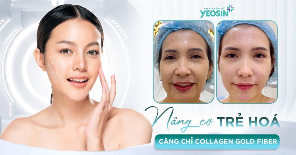 Hiệu quả nhận được sau khi nâng cơ trẻ hóa căng da mặt tại Viện Thẩm Mỹ Yeosin.