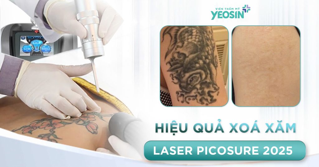 Hiệu quả khi xóa xăm không sẹo tại Viện Thẩm Mỹ Yeosin đạt 99%