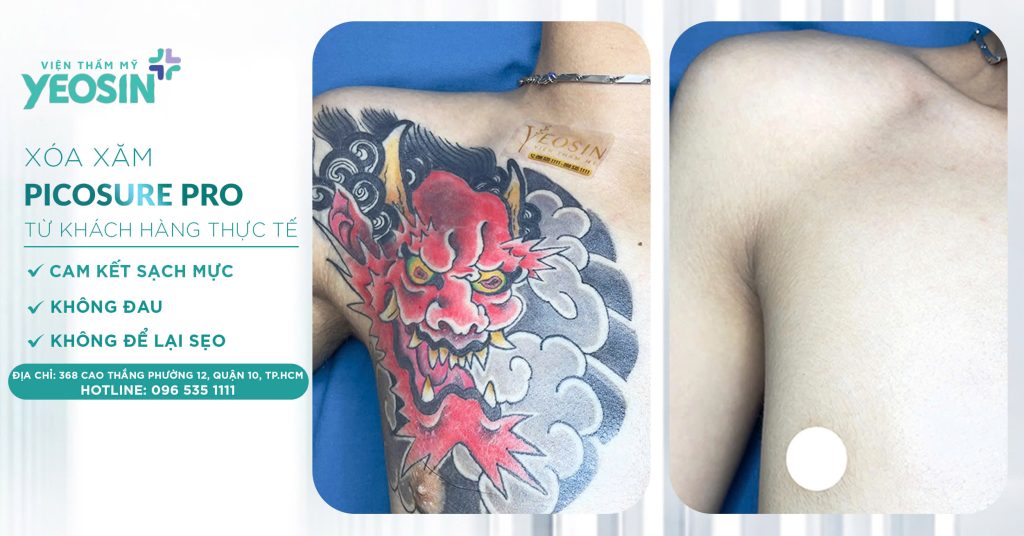 Xóa hình xăm không để lại sẹo - Phòng Khám Thẩm Mỹ Yeosin 22 z6537921930286 29319722d16a382f2e3c8b004a891d0b 1