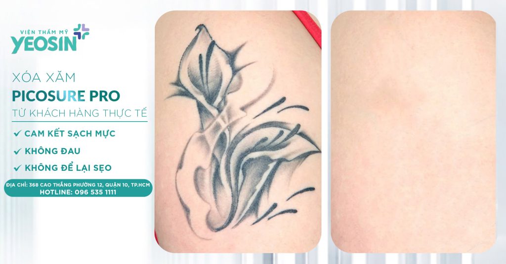 Xóa hình xăm không để lại sẹo - Phòng Khám Thẩm Mỹ Yeosin 23 z6537921930287 2b81cd12982b09b69c5080ce29d8efad 1