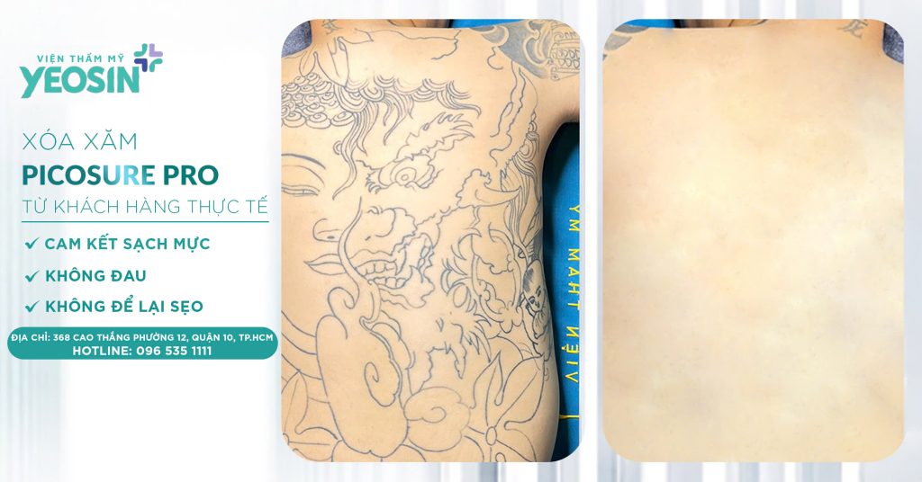 Xóa hình xăm không để lại sẹo - Phòng Khám Thẩm Mỹ Yeosin 25 z6537921930290 b2a7202ac701febc3ba8f350af318a11 1