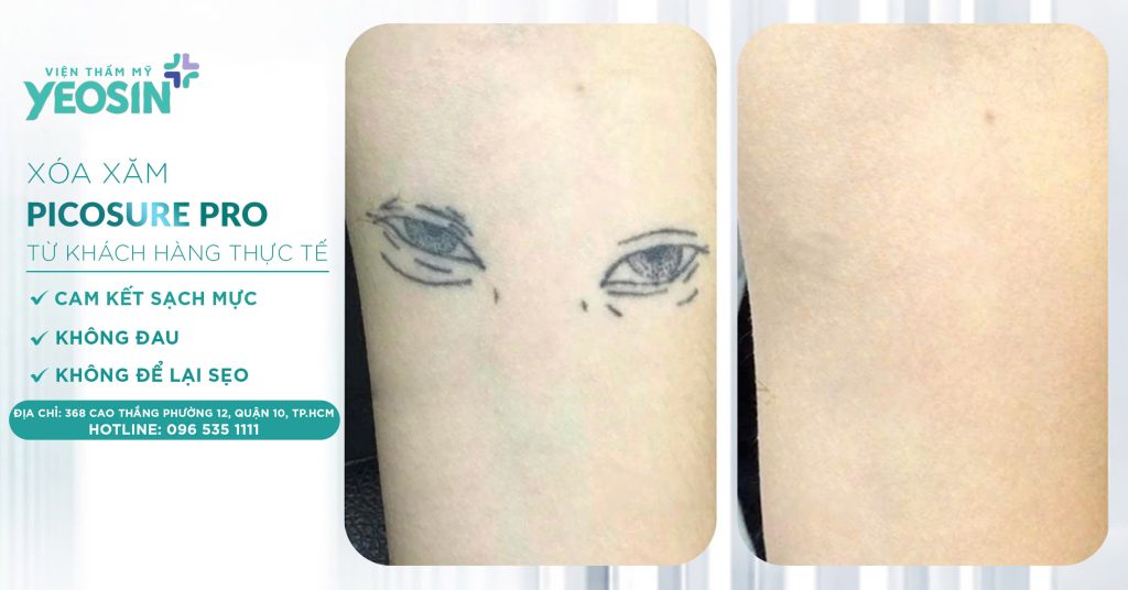 Xóa hình xăm không để lại sẹo - Phòng Khám Thẩm Mỹ Yeosin 27 z6537921930292 3dc6e6e35176f27df7aa16e3a1d32ebd 1