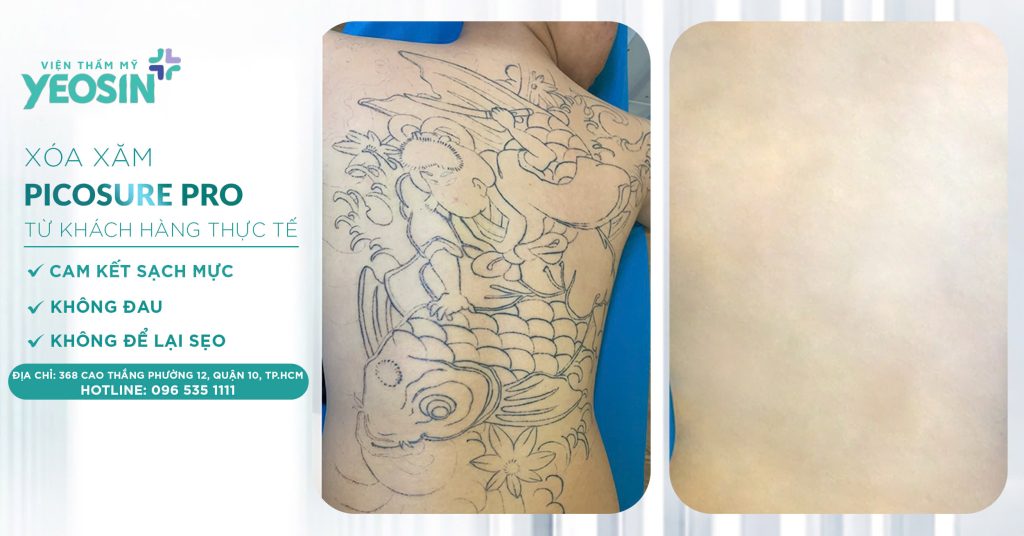 Xóa hình xăm không để lại sẹo - Phòng Khám Thẩm Mỹ Yeosin 30 z6537921930295 0e2582eca0af0f2a02c469c485a59e0d 1