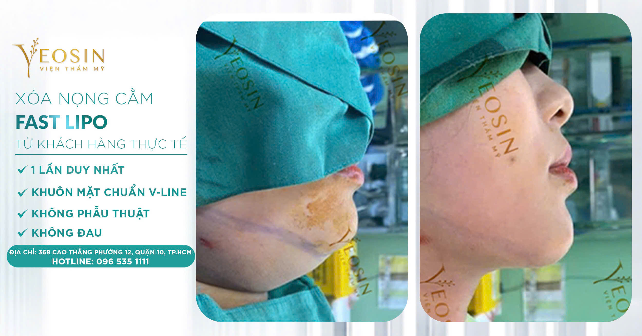 5 Cách giảm mỡ nọng cằm hiệu quả nhanh hiện nay 22 z6539532292036 37acad30b1feadf49120e598e7dc90bc