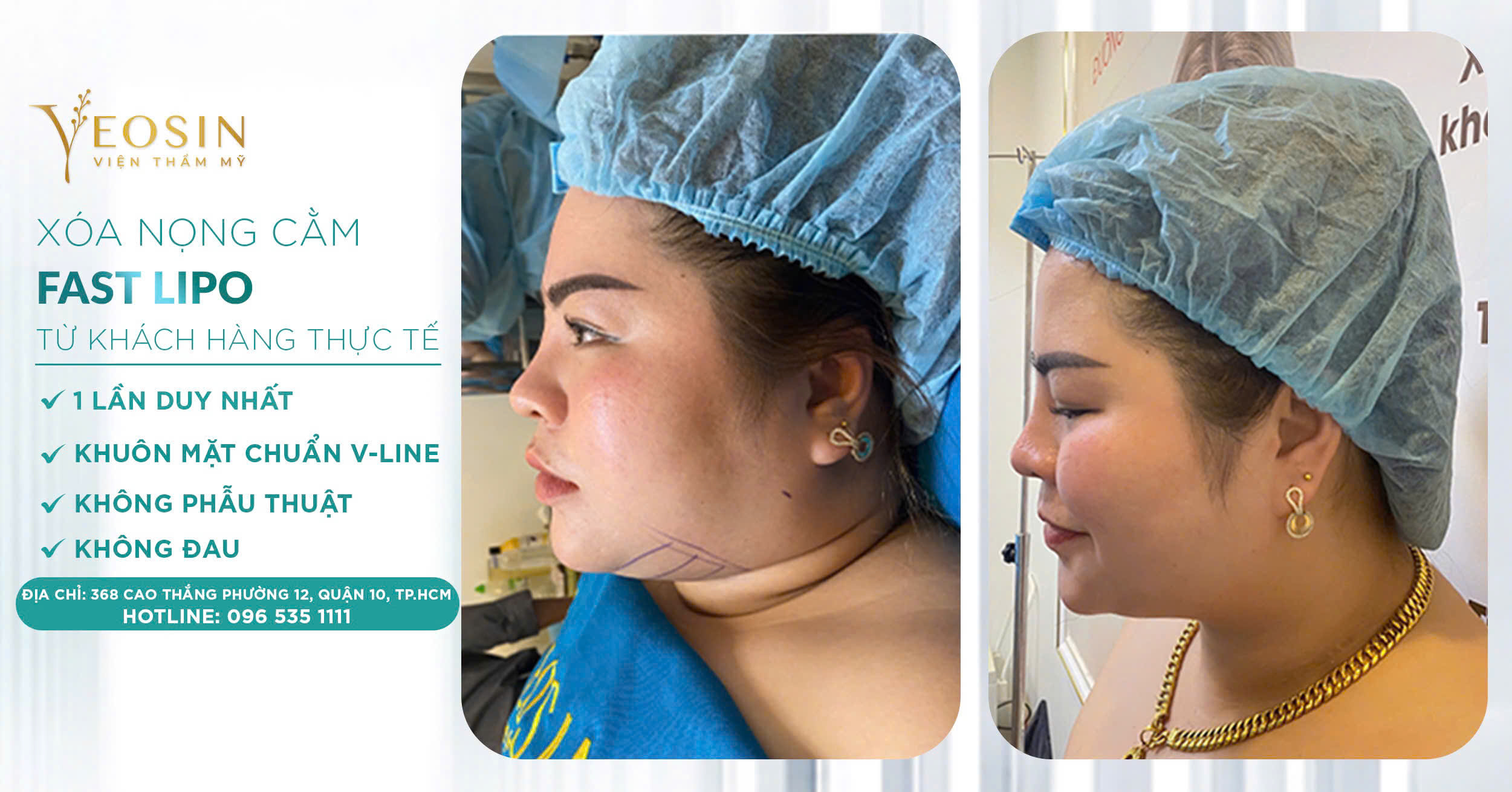 5 Cách giảm mỡ nọng cằm hiệu quả nhanh hiện nay 24 z6539532306978 0ab0d87bcf6e3d6c5a284985aafc06cd