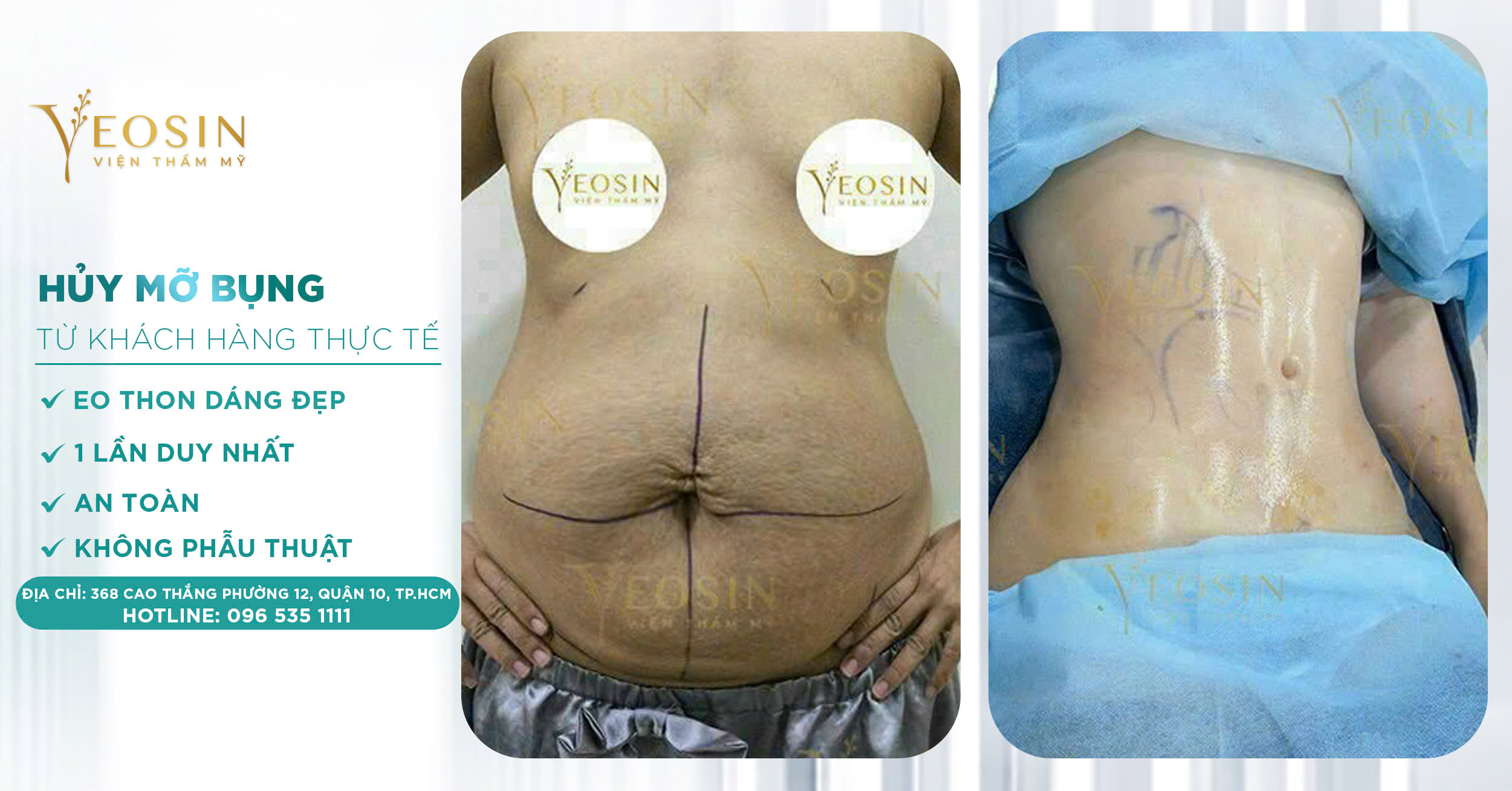 Giảm mỡ bụng hiệu quả, an toàn bằng công nghệ cao 23 z6550427545579 24b8ab38066b6676c0634107c2685bcb