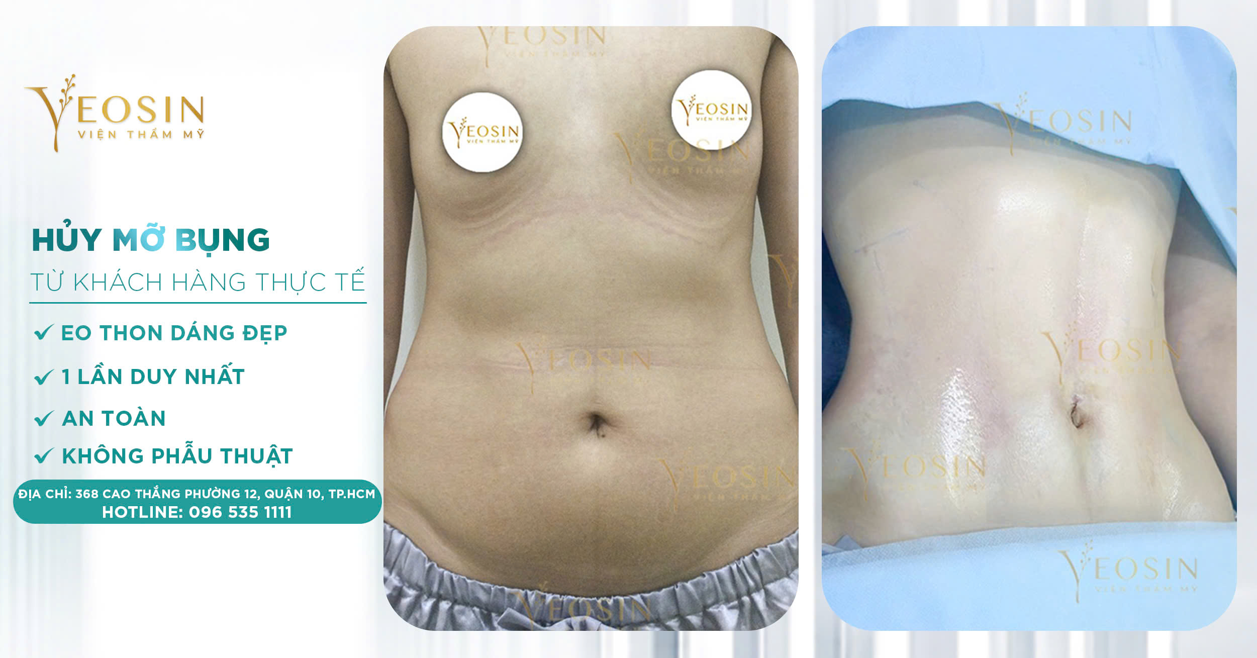 Giảm mỡ bụng hiệu quả, an toàn bằng công nghệ cao 25 z6550427551344 1559b91fb1f6eac30847167816aaa90d