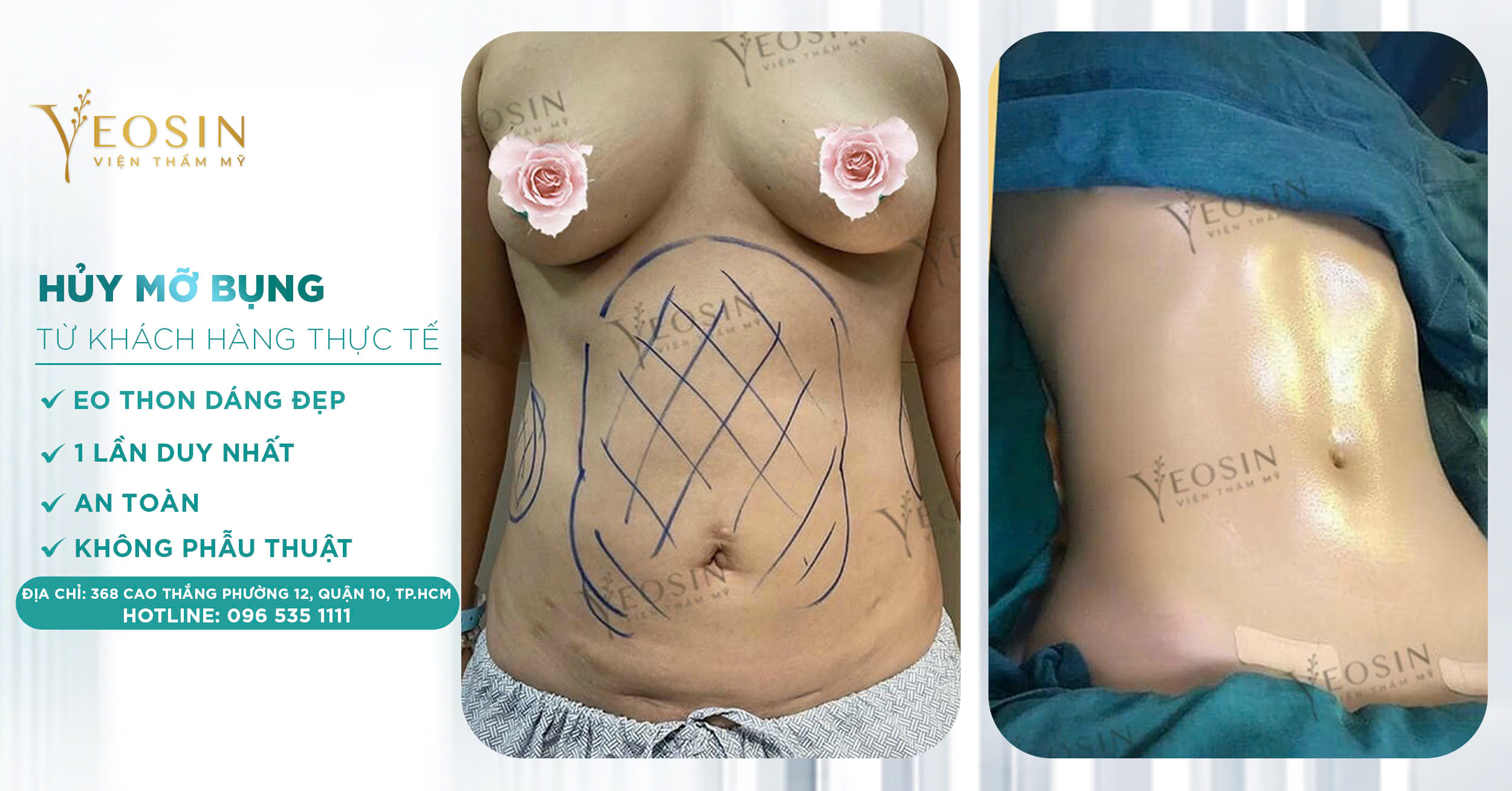 Giảm mỡ bụng hiệu quả, an toàn bằng công nghệ cao 26 z6550427556102 bd49b0802fc02ad5990e9511104fb948