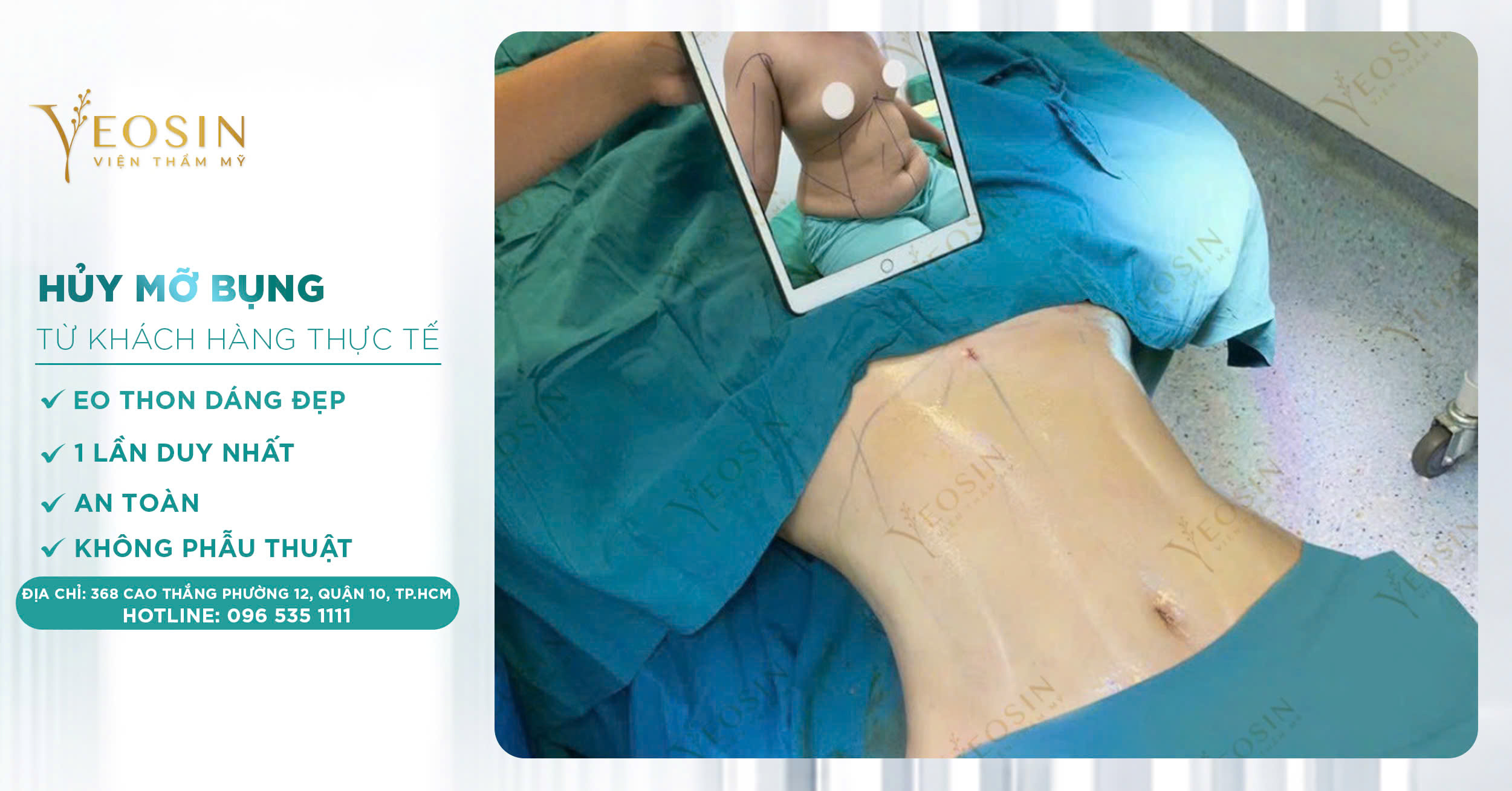 Giảm mỡ bụng hiệu quả, an toàn bằng công nghệ cao 28 z6550427573424 74849c034a03cf309801f2dfd737d779