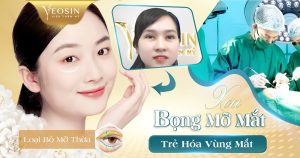 Xóa bọng mỡ mắt