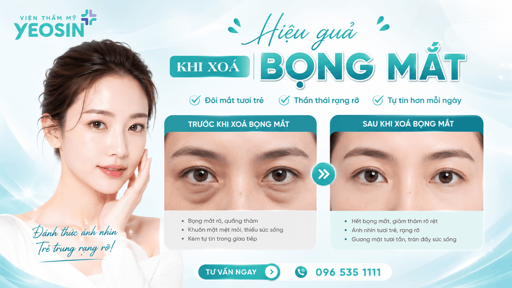 Hiệu quả nhận được sau khi xóa bọng mỡ mắt tại Yeosin