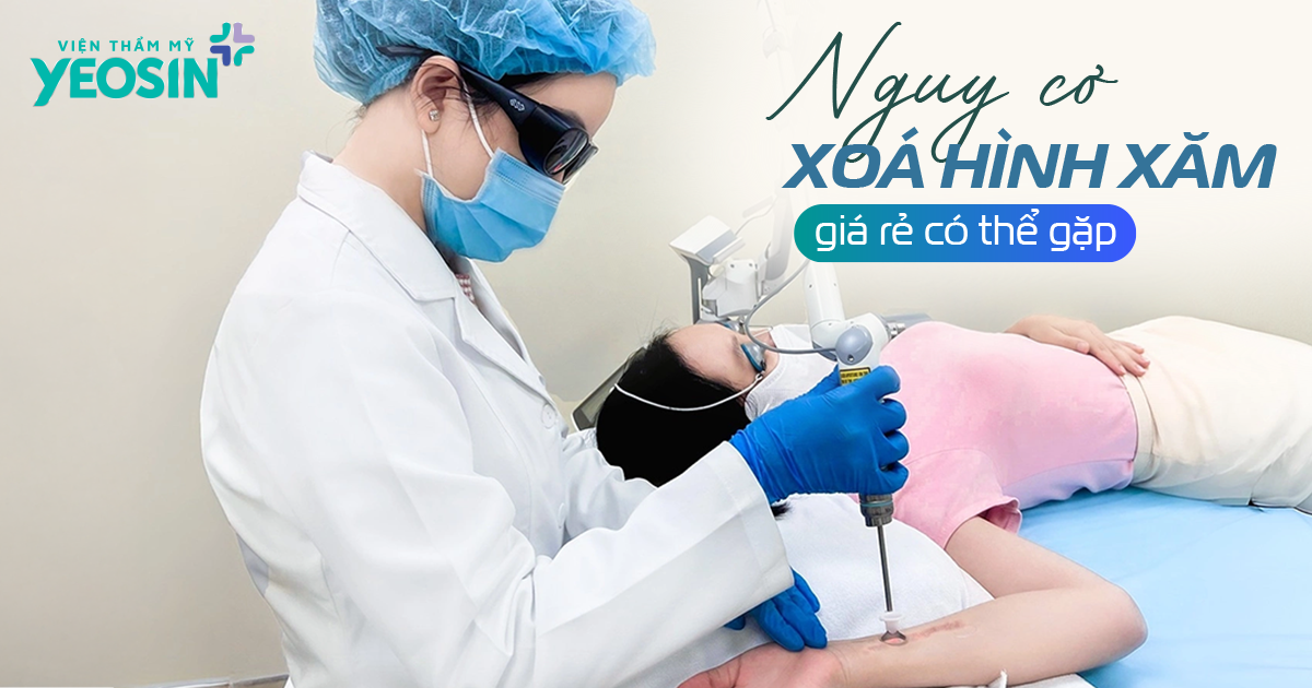 Giá xóa hình xăm - Bảng giá xóa xăm mới 2026 28 5