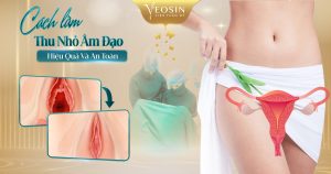 cách làm thu nhỏ âm đạo