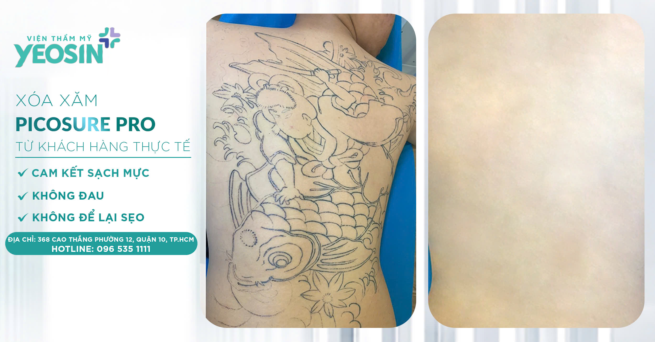 Giá xóa hình xăm - Bảng giá xóa xăm mới 2026 34 a