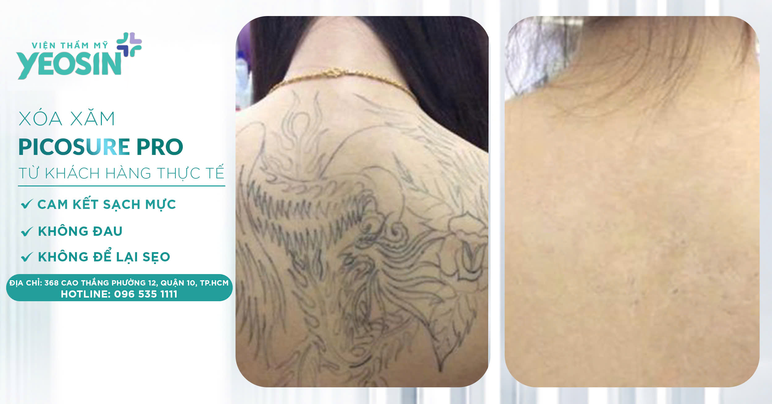 Giá xóa hình xăm - Bảng giá xóa xăm mới 2026 36 z6537921930286 29319722d16a382f2e3c8b004a891d0b