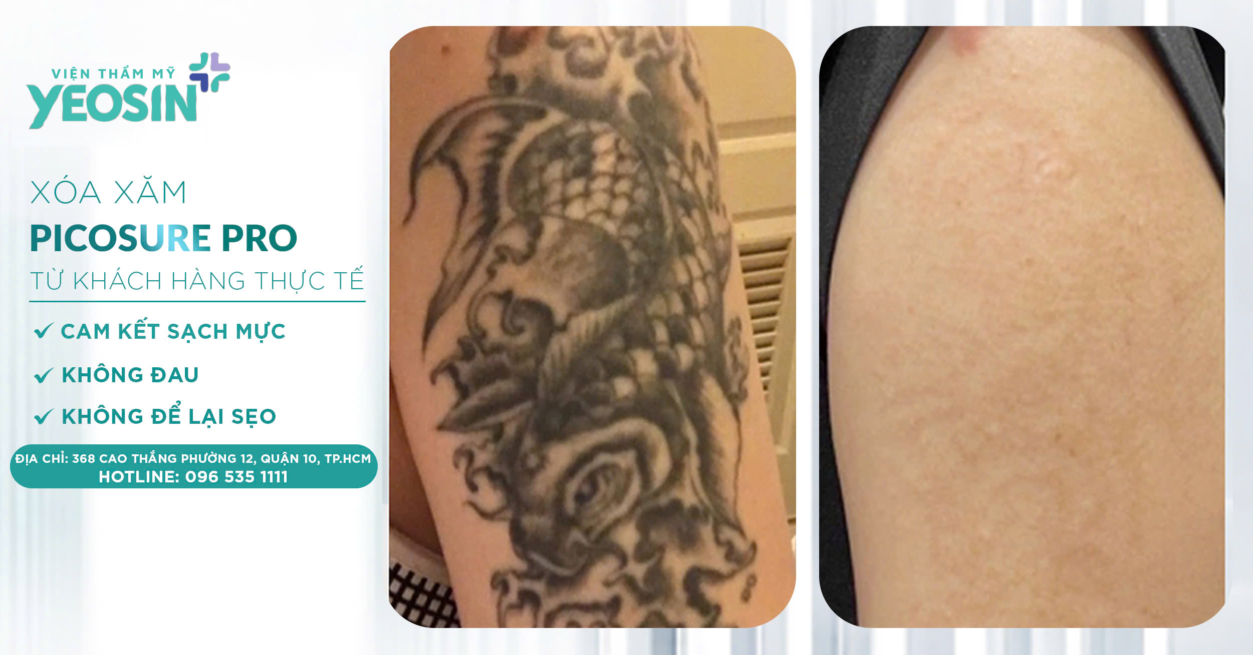 Giá xóa hình xăm - Bảng giá xóa xăm mới 2026 38 z6537921930288 5b6607ab17105de21a8d7d9f3c4cdca7