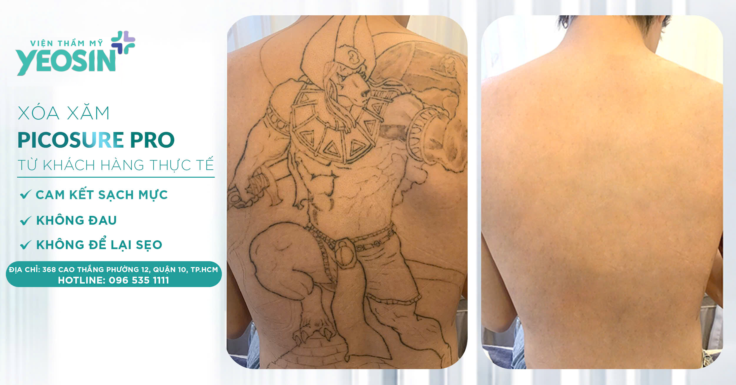 Giá xóa hình xăm - Bảng giá xóa xăm mới 2026 40 z6537921930290 b2a7202ac701febc3ba8f350af318a11