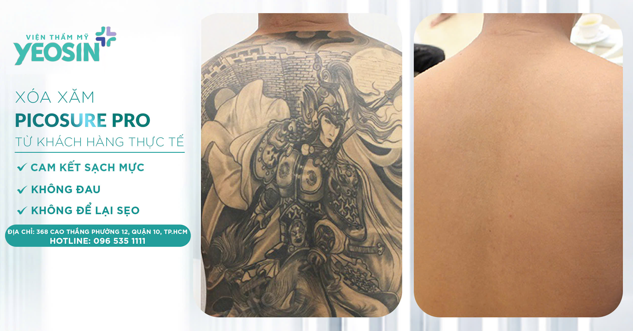 Giá xóa hình xăm - Bảng giá xóa xăm mới 2026 43 z6537921930294 ef18da03a04fa6b101a6a338f9d266b3