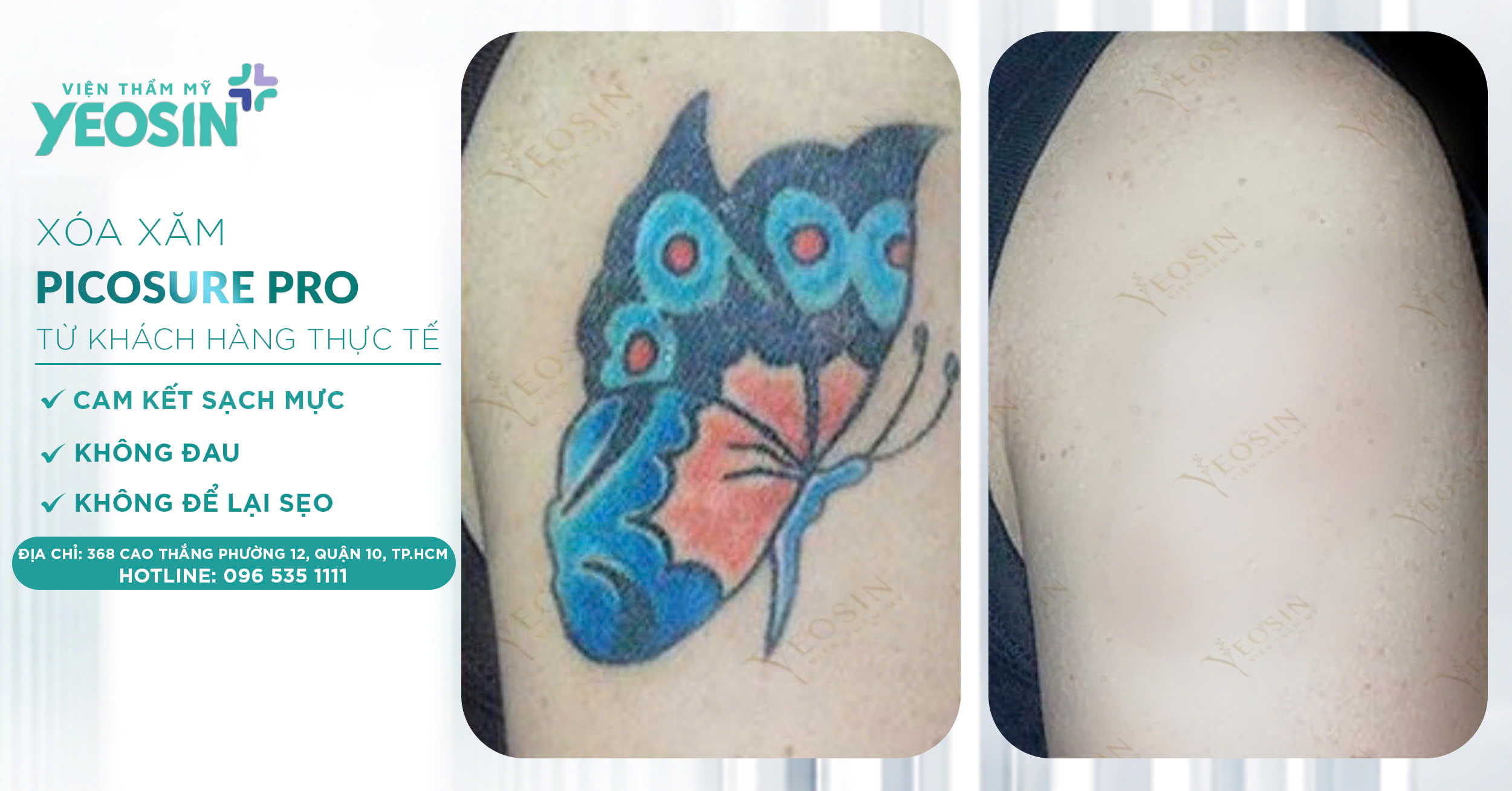 Giá xóa hình xăm - Bảng giá xóa xăm mới 2026 44 z6537921930295 0e2582eca0af0f2a02c469c485a59e0d