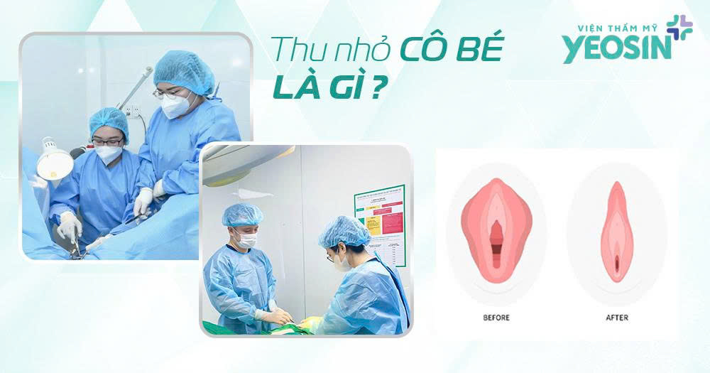 Thẩm mỹ thu nhỏ cô bé là gì?