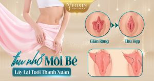 Thu nhỏ môi bé - Bí quyết lấy lại tuổi thanh xuân