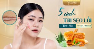 BANNER BLOG Top 5 cach dieu tri seo loi tren mat hieu qua