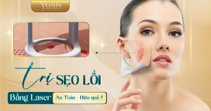 Cách trị sẹo lồi ở mũi bằng laser