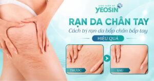 Rạn da chân tay - Cách trị rạn da bắp chân bắp tay hiệu quả
