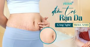 Viện Thẩm Mỹ Yeosin - Địa chỉ điều trị rạn da uy tín nhất tại TPHCM