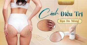 BANNER Ran da mong – Nguyen nhan bi ran da o mong va cach tri