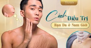 Cách điều trị rạn da cho nam giới bằng công nghệ Small Nano