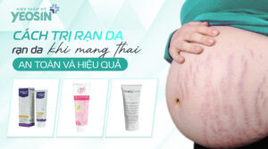 cách-trị-rạn-da-sau-sinh (1)
