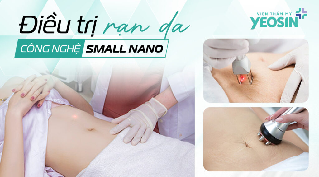 Cách trị rạn da tuổi dậy thì an toàn và hiệu quả 9 dieu tri ran da bang small nano 1