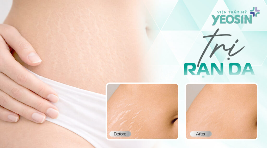 trị-rạn-da