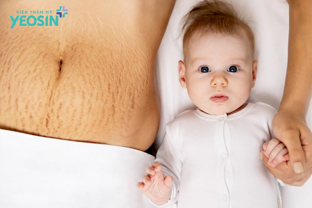 Top 5 cách trị rạn da sau sinh an toàn và hiệu quả 6 tri-ran-da-sau-sinh-1